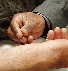 [1] Einsatz der Akupunktur am Arm eines Patienten