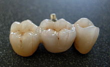[2] Brücke aus Keramik für drei Zähne