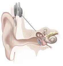 [1] Implantat in der Cochlea