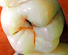 [1] ein Loch im Zahn, verursacht durch Karies