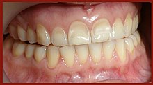 [2] Durch Säuren wird Erosion an Zähnen ausgelöst