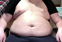 [3] das Fett dieses übergewichtigen Jungen quillt über seinen Hosenbund
