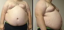 [3] Bauch eines Übergewichtigen