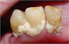 [2] Beläge auf den Zähnen