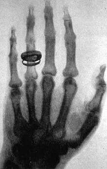 [1] eine Röntgenaufnahme der Knochen der menschlichen Hand